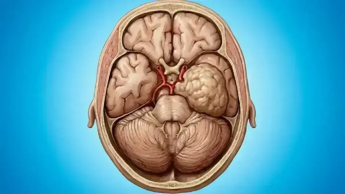 🦴 Meningioma Petroclival