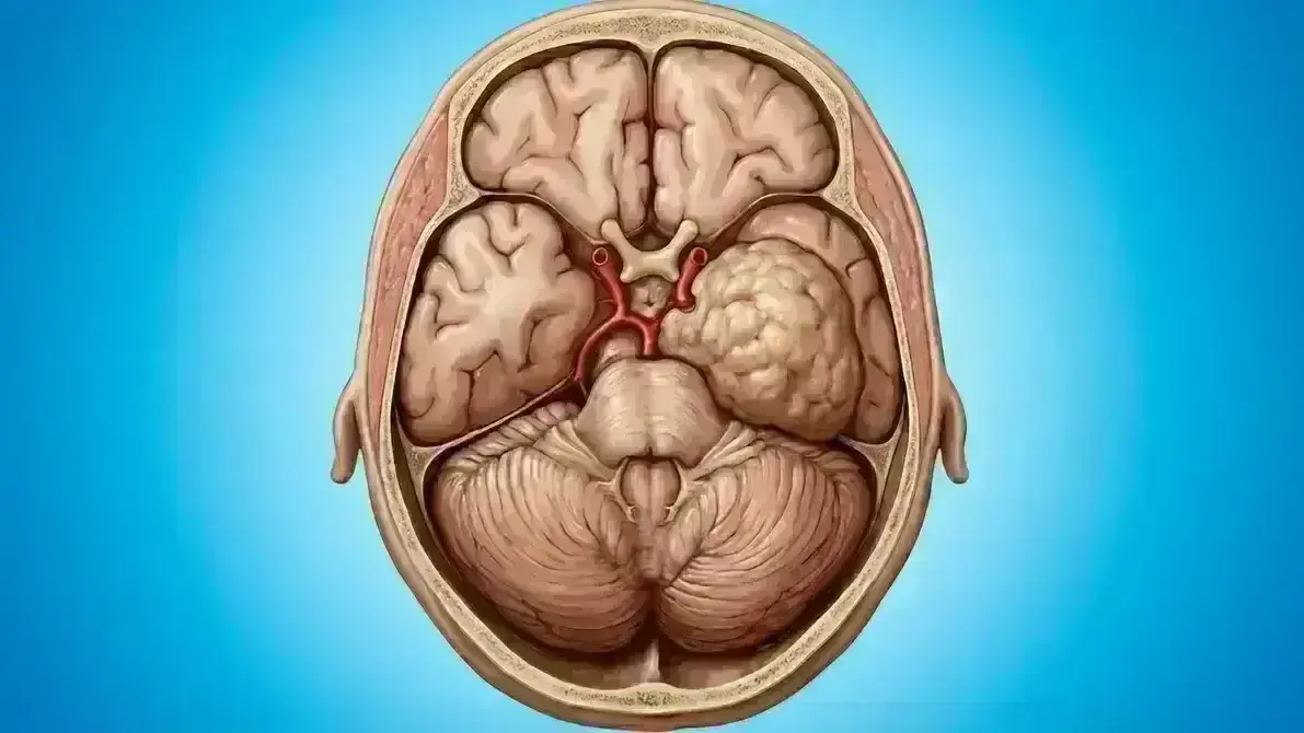 Meningioma Petroclival