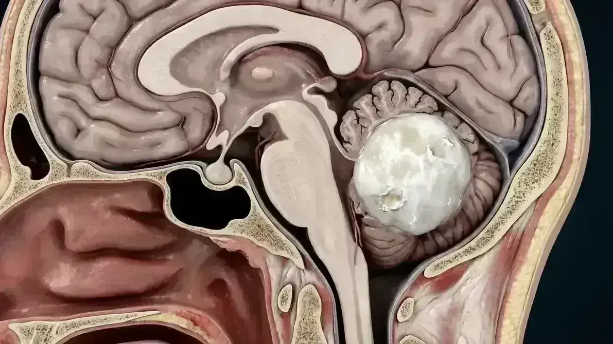 🎯 Metástase Cerebelar Solitária