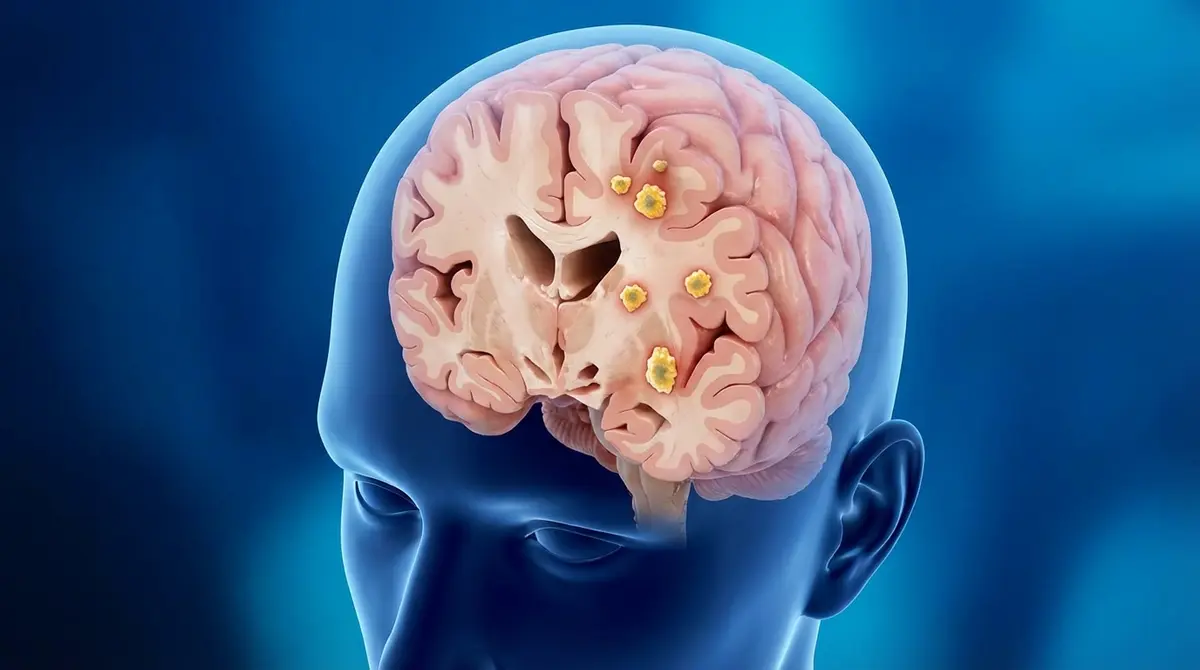 🎯 Metástases Cerebrais Múltiplas