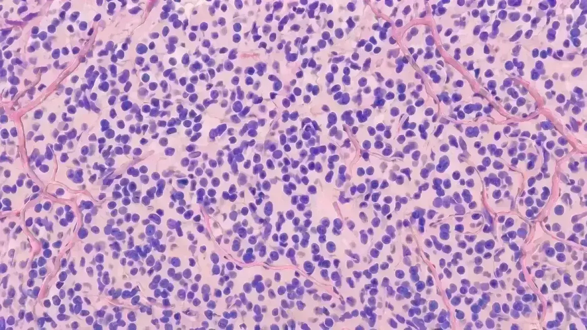 🧠 Oligodendroglioma Anaplásico Grau 3