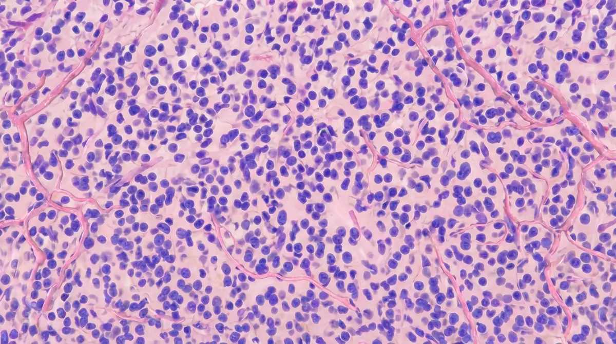 Oligodendroglioma Anaplásico Grau 3