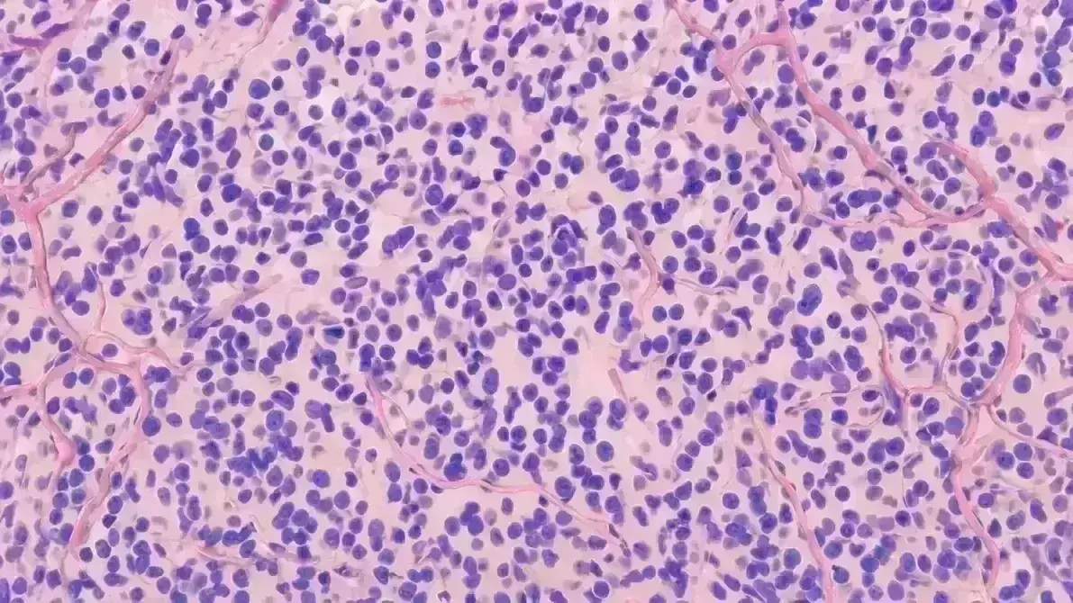 Oligodendroglioma Anaplásico Grau 3