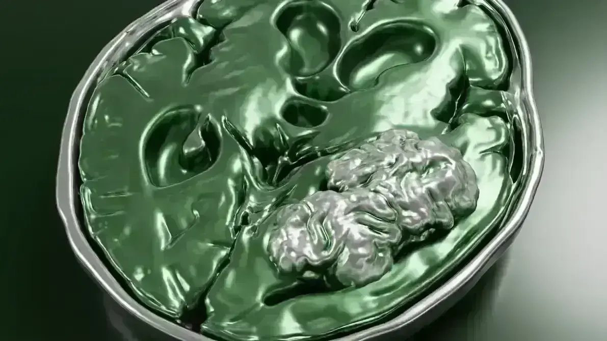 🚰 Papiloma de Plexo Coroide