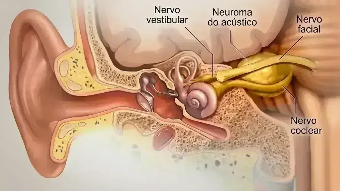 👂 Schwannoma Vestibular (Neurinoma do Acústico)