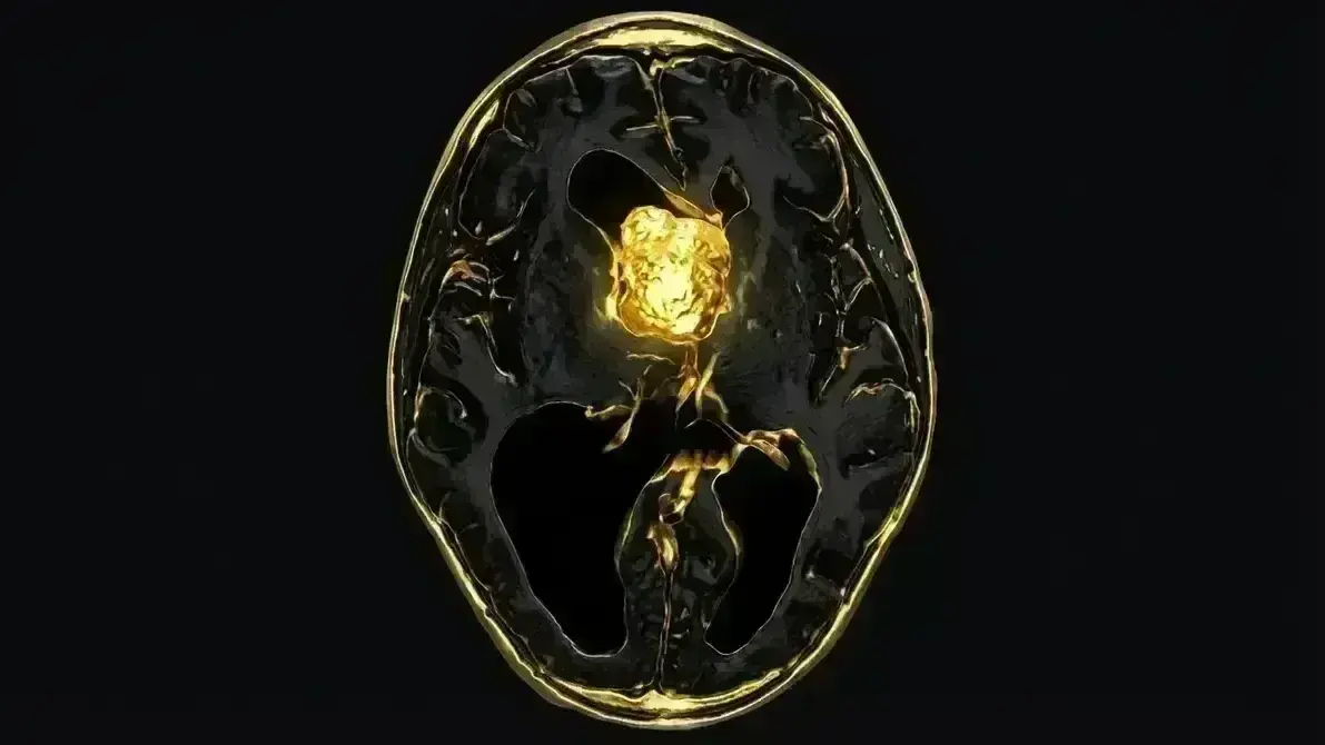 🧠 Tumor de Células Gigantes Subependimário