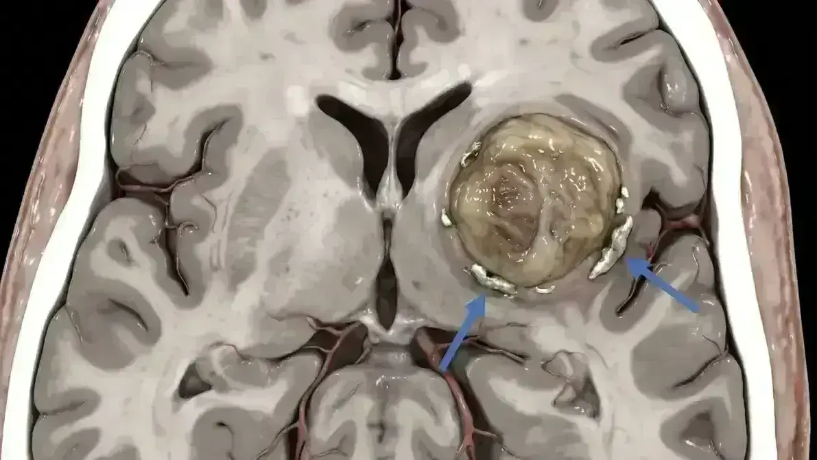 🧈 Tumor Dermoide Intracraniano