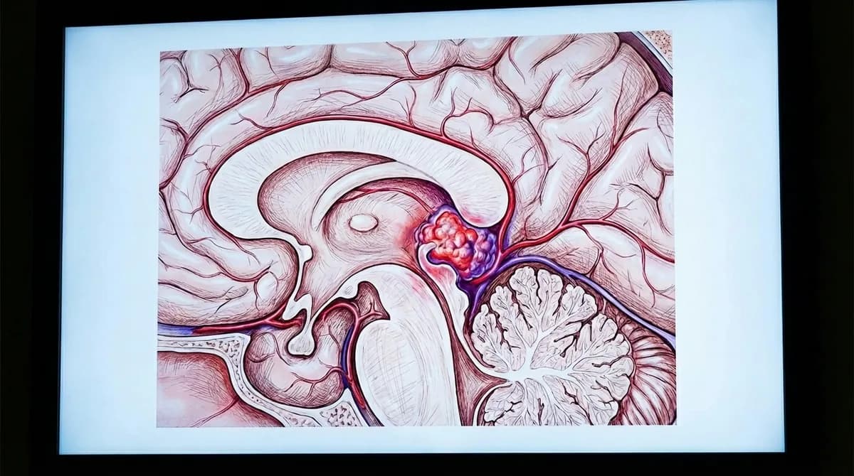 Tumor Germinativo do SNC